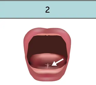 Tongue fixed to bottom of mouth
